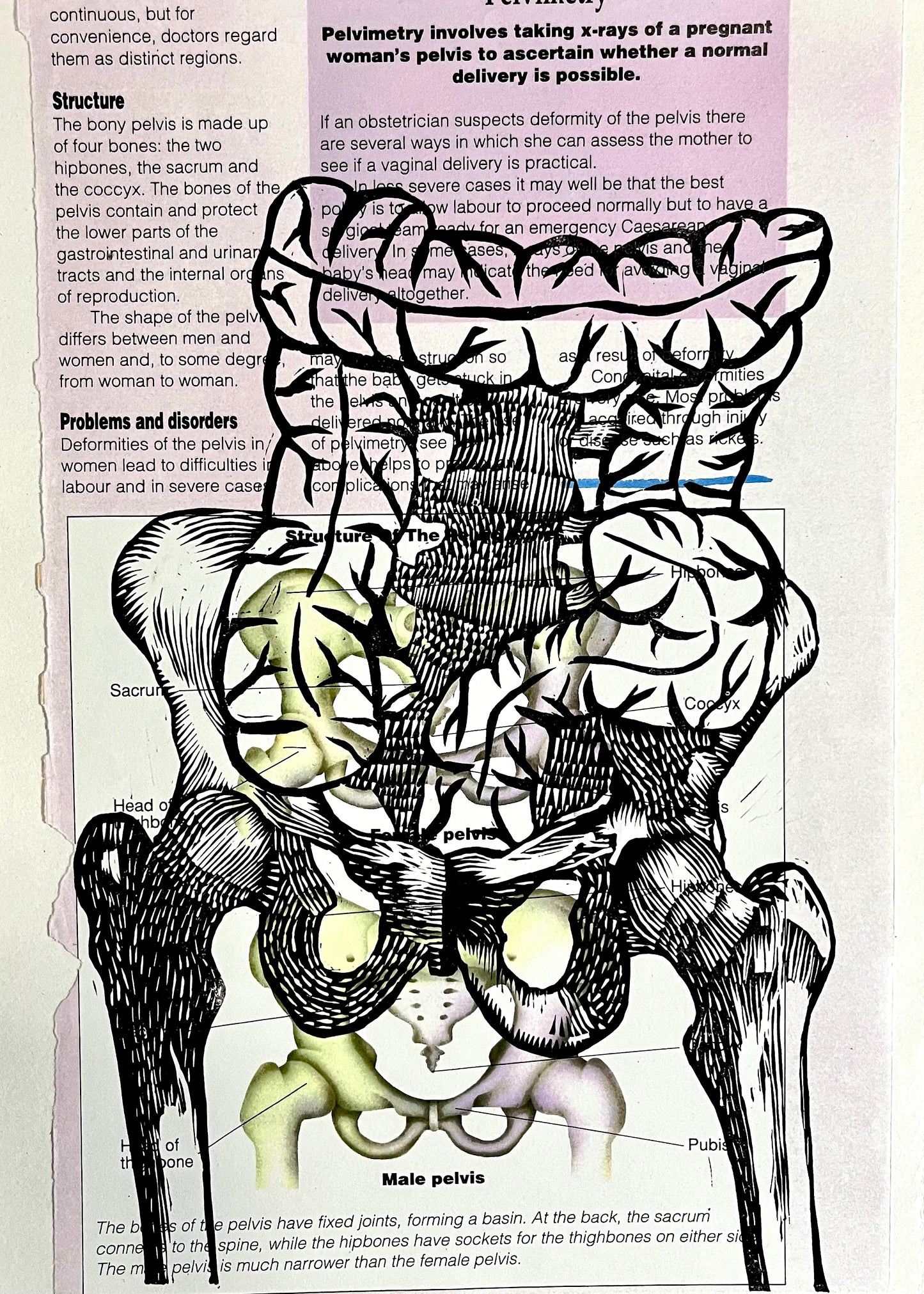 Impaction 3